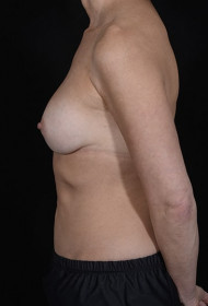 Breast Revision