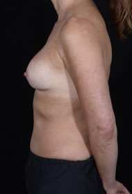 Breast Revision