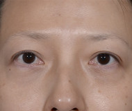 Blepharoplasty