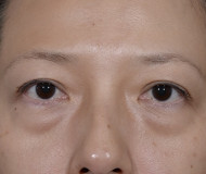 Blepharoplasty