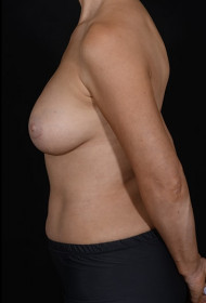 Breast Augmentation