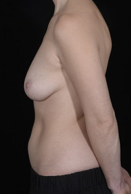 Breast Augmentation