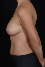 Liposuction