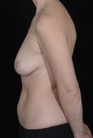 Liposuction