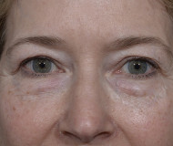 Blepharoplasty