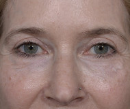 Laser Resurfacing