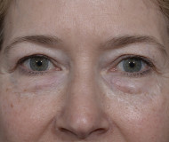 Laser Resurfacing