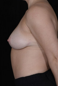 Breast Reduction