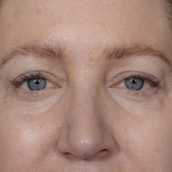 Brow Lift