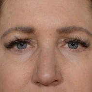 Brow Lift