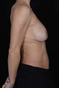 Breast Revision