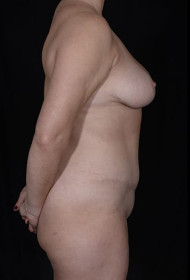 Breast Reduction