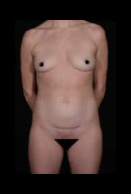 Abdominoplasty