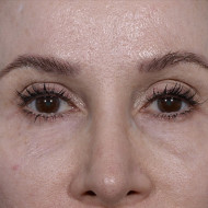 Brow Lift