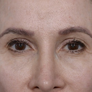 Brow Lift