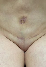 Umbilicoplasty