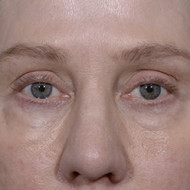 Blepharoplasty