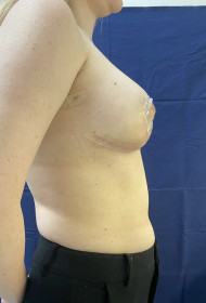 Breast Reduction