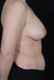 Breast Reduction