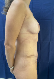 Breast Uplift – Augmentation