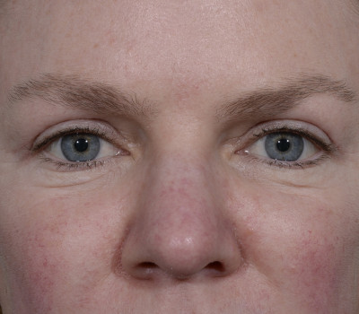 Blepharoplasty