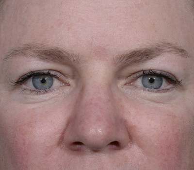 Blepharoplasty